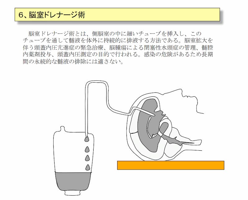 脳髄液が溜まった水頭症の治療法