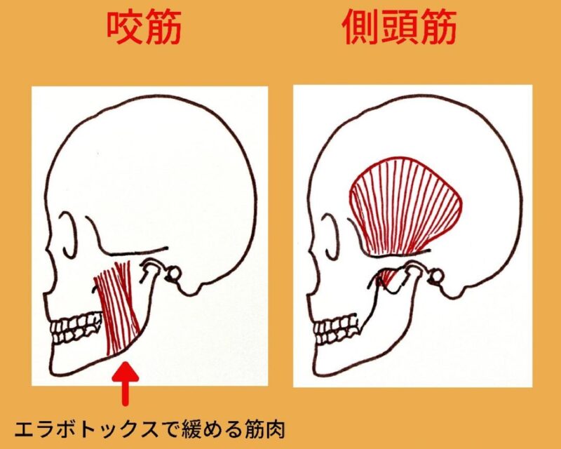 咬筋・側頭筋