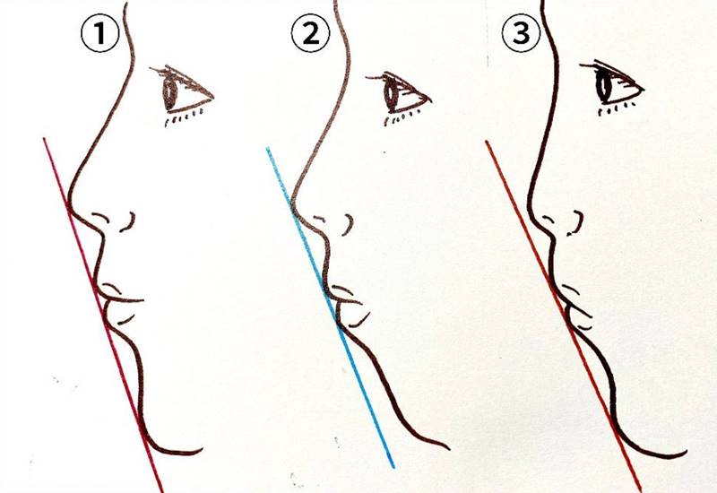 日本人の場合であれば、①が理想的、②は下あごが後退している、③は鼻先が低いというようにEラインは美容外科的な観点から分類されます