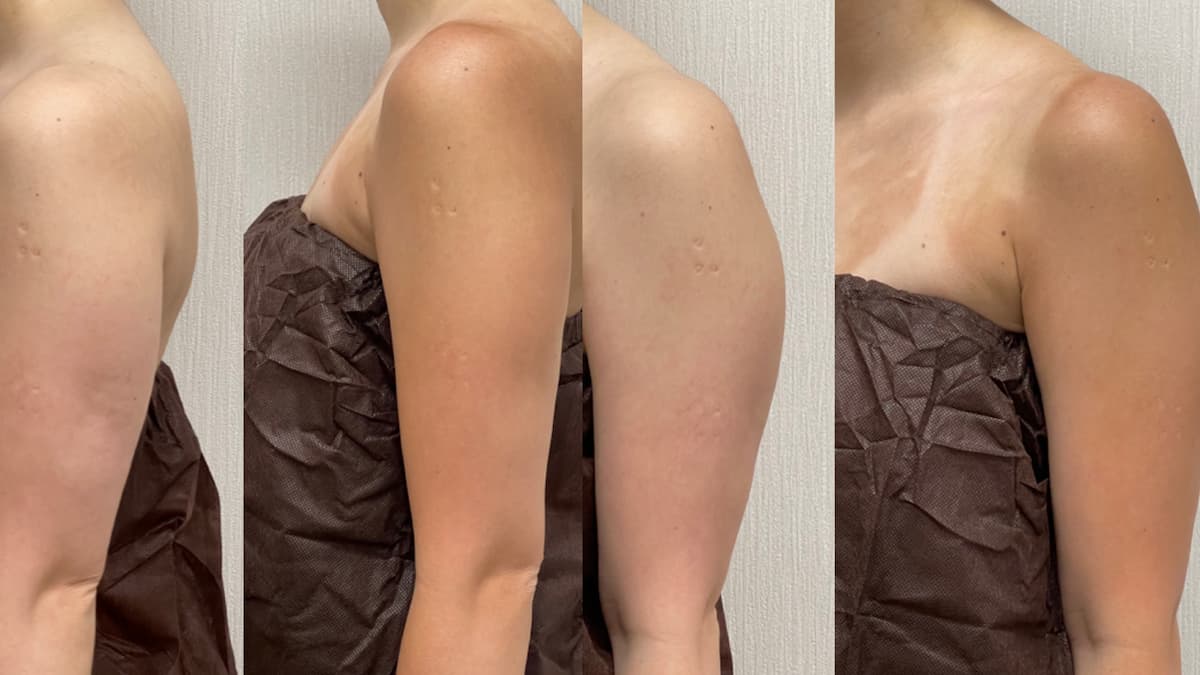 安全で効果的な二の腕の脂肪吸引、ジェンナーのごとく我が子で実験(笑)