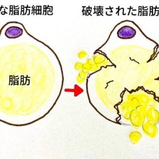 正常な脂肪細胞・破壊された脂肪細胞