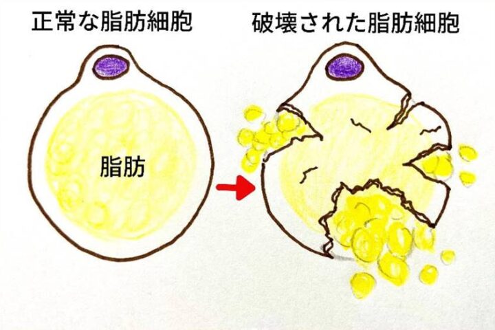 切らずに「顔やせ」「小顔に」効果長持ち脂肪溶解注射とは