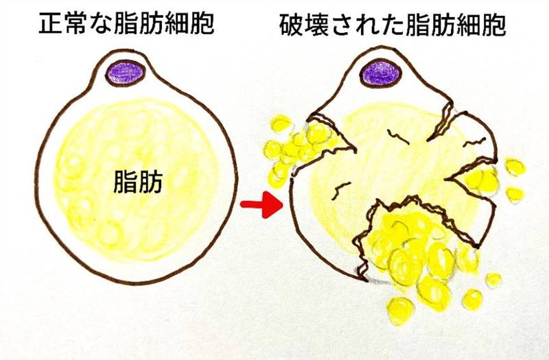 切らずに 顔やせ 小顔に 効果長持ち脂肪溶解注射とは Dr 松下ブログ 五本木クリニック