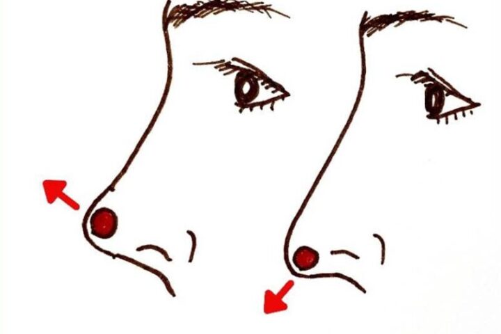 プチ整形で鼻を高くするオステオポア（オステオポール）は本当に安全なのか？
