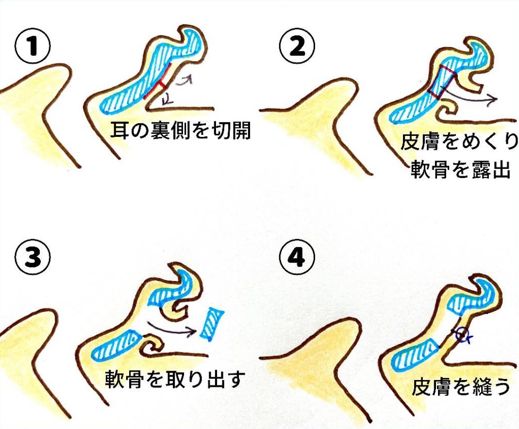 耳介軟骨を採取する手順
