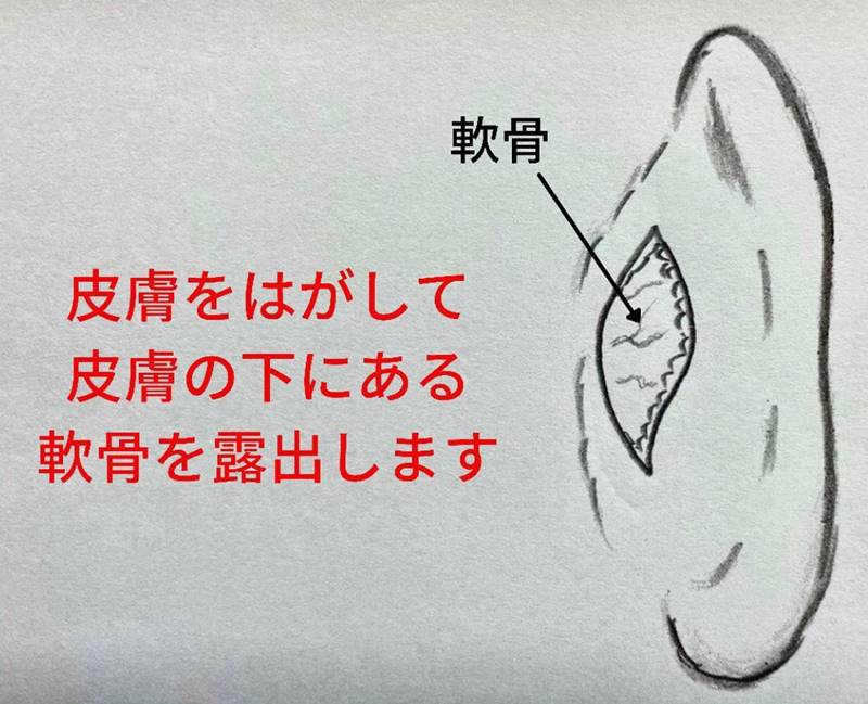 右耳の皮膚を剥がして皮膚の下にある軟骨を露出します