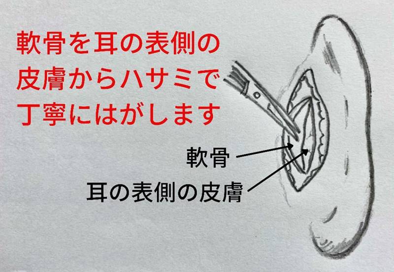 軟骨を耳の表側の皮膚からハサミで丁寧に剥がします