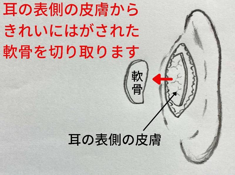 耳の表側の皮膚からきれいに剥がされた軟骨を切り取ります