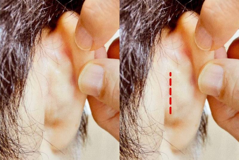 耳介軟骨を取った後の傷あと