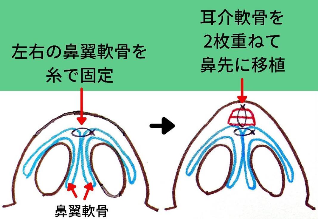 鼻に耳介軟骨を移植する