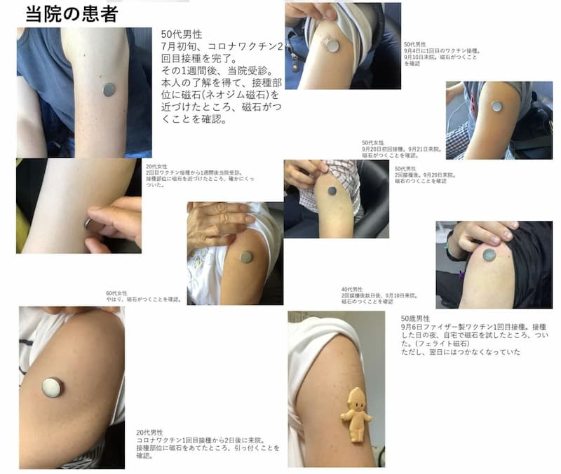 ナカムラクリニック、ワクチン接種後に磁石がからだにくっつく人々