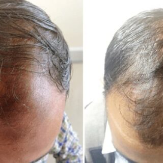 PRPによる発毛治療の効果