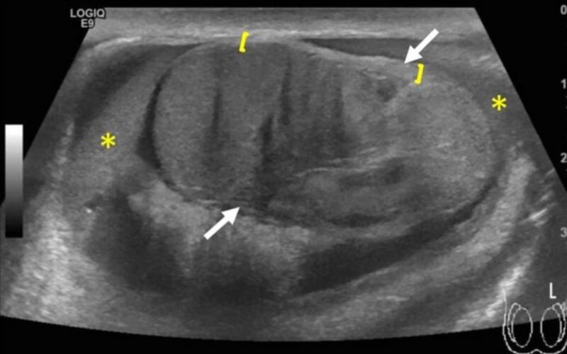 睾丸破裂エコー画像