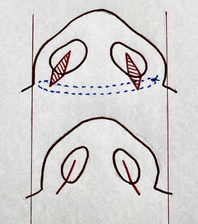 小鼻縮小手術のコツ