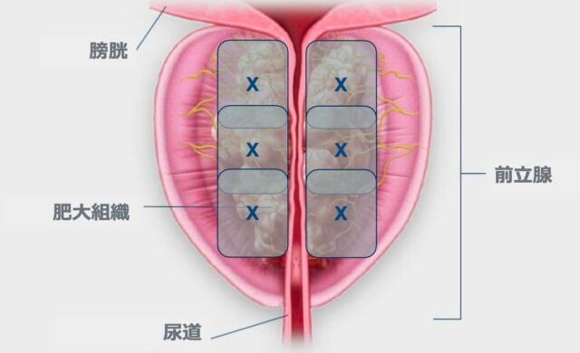 前立腺肥大症をレジュームで治療する場所