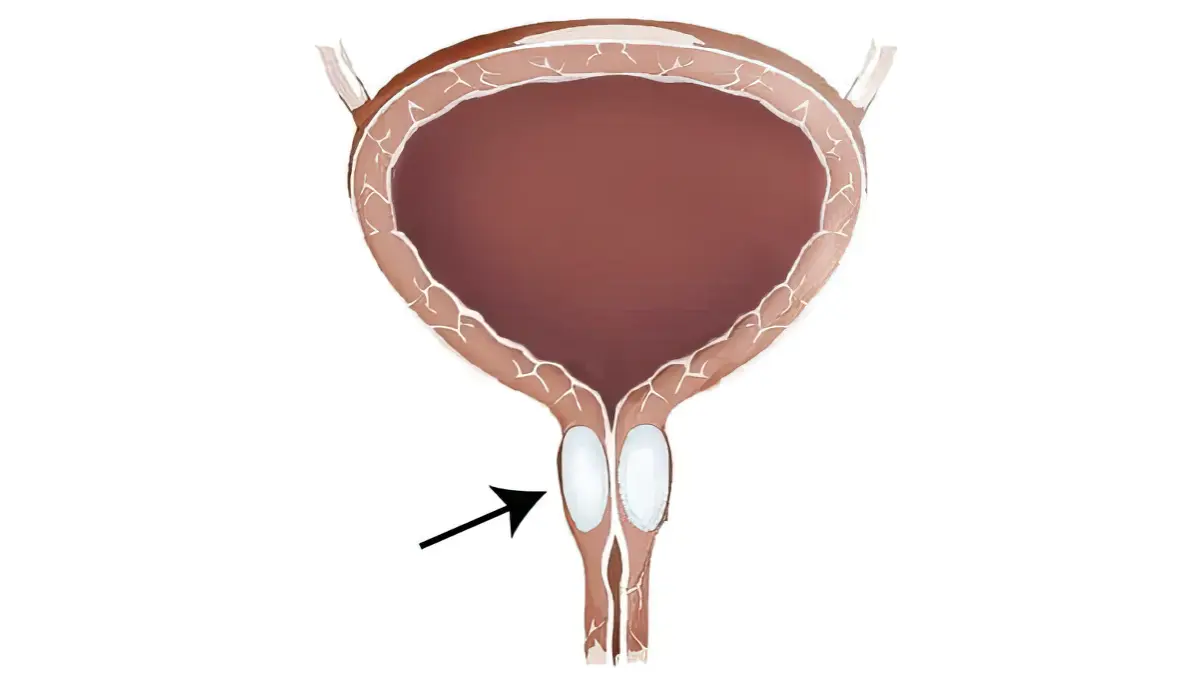 尿道周囲注入術（periurethral injection of bulking agent）